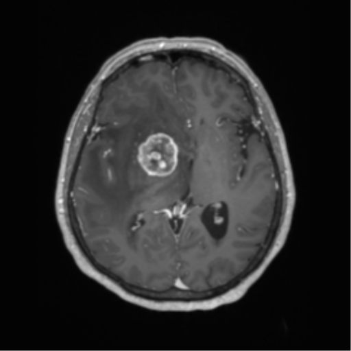 Cerebral metastasis to basal ganglia (Radiopaedia 81568-95413 Axial T1 C+ 36).png