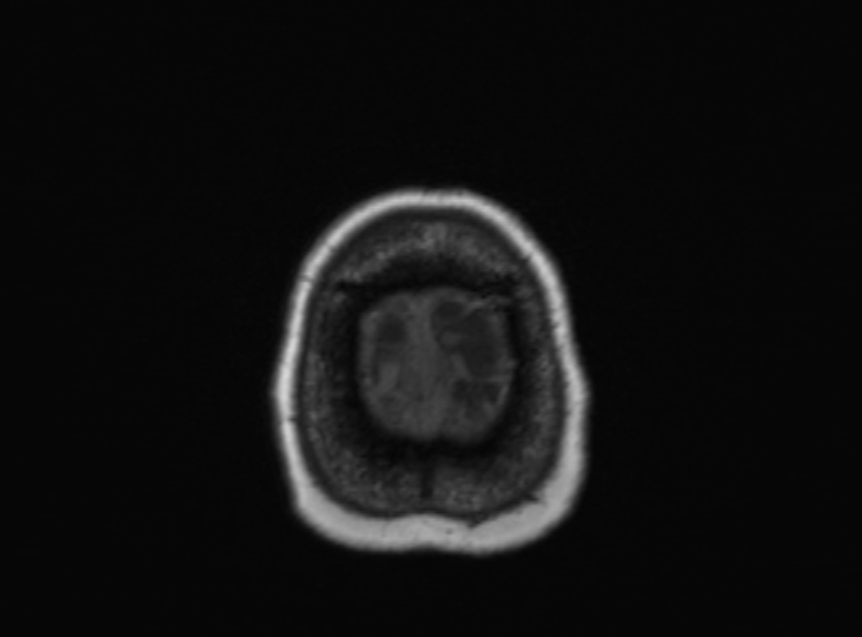Cerebral ring enhancing lesions - cerebral metastases (Radiopaedia 44922-48817 Axial T1 103).jpg