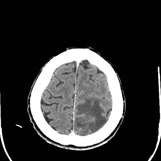 File:Cerebral toxoplasmosis (Radiopaedia 43956-47460 Axial C+ delayed 37).jpg