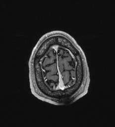 Cerebral toxoplasmosis (Radiopaedia 43956-47461 Axial T1 C+ 71).jpg