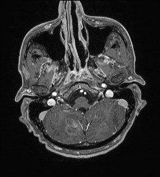 Cerebral toxoplasmosis (Radiopaedia 43956-47461 Axial T1 C+ 9).jpg