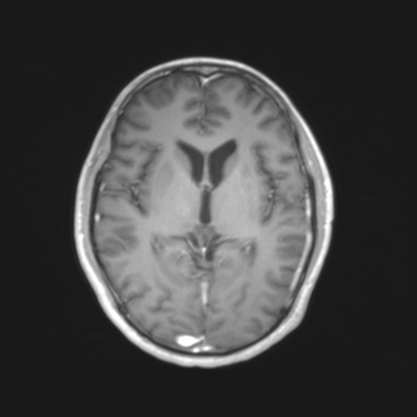 File:Cerebral toxoplasmosis (Radiopaedia 53993-61435 Axial T1 11).jpg