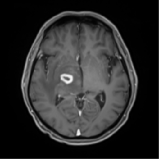 Cerebral toxoplasmosis (Radiopaedia 54575-60804 Axial T1 C+ 27).png