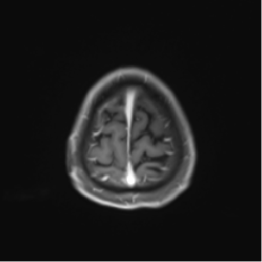 Cerebral toxoplasmosis (Radiopaedia 54575-60804 Axial T1 C+ 49).png