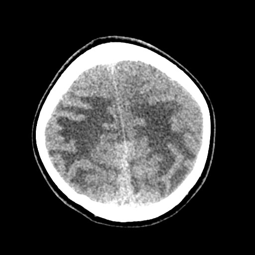 Cerebral tuberculosis with dural sinus invasion (Radiopaedia 60353-68018 Axial non-contrast 49).jpg