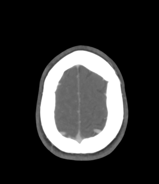 File:Cerebral venous hemorrhagic infarction (Radiopaedia 38461-40550 Axial MIP VENOGRAM 46).png