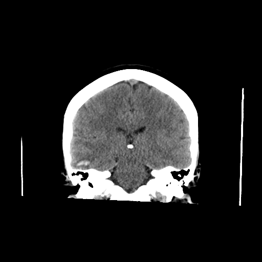 File:Cerebral venous infarct related to dural venous sinus thromboses (Radiopaedia 35292-36804 Axial non-contrast 1).png