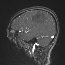 Cerebral venous infarction - hemorrhagic (Radiopaedia 81625-95505 Sagittal MRV 21).jpg