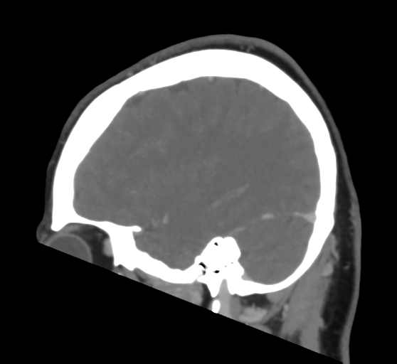 Cerebral venous infarction due to transverse sinus thrombosis (Radiopaedia 34688-36120 Sagittal CT venogram 39).png