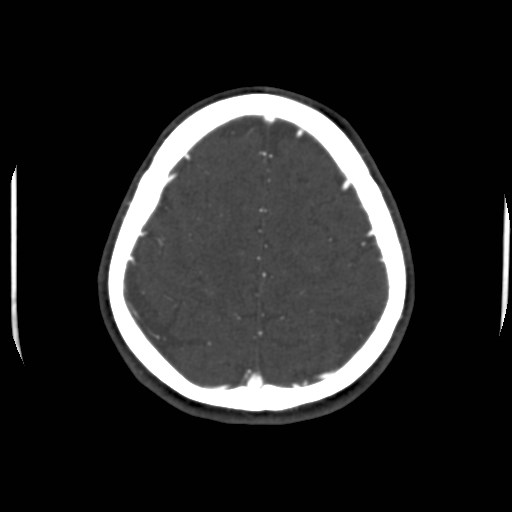 Cerebral venous sinus thrombosis (Radiopaedia 40619-43227 A 188).jpg