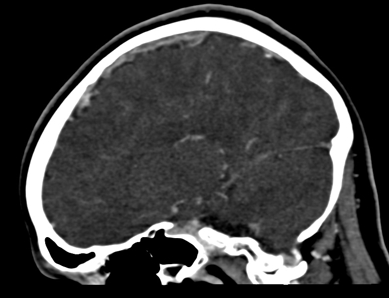 Cerebral venous sinus thrombosis (Radiopaedia 59224-66646 Sagittal C+ delayed 16).jpg