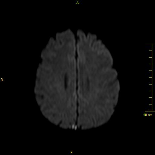 File:Cerebral venous thrombosis (Radiopaedia 23288-23351 Axial DWI 29).JPG