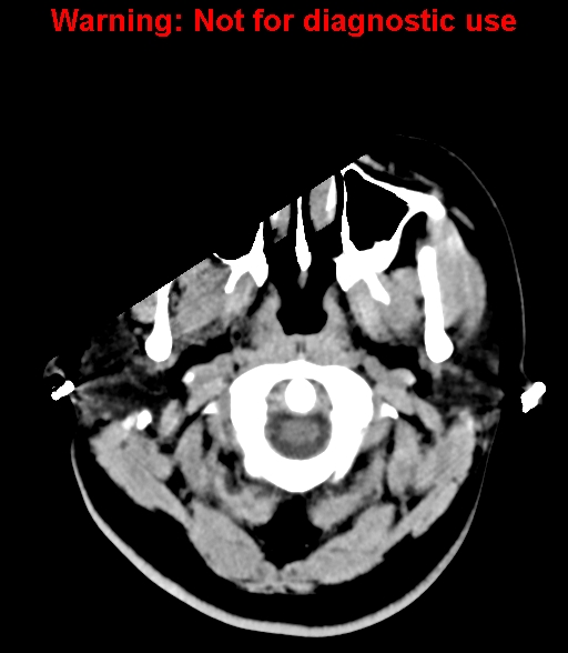 File:Cerebral venous thrombosis (Radiopaedia 37224-38992 Axial non-contrast 2).jpg
