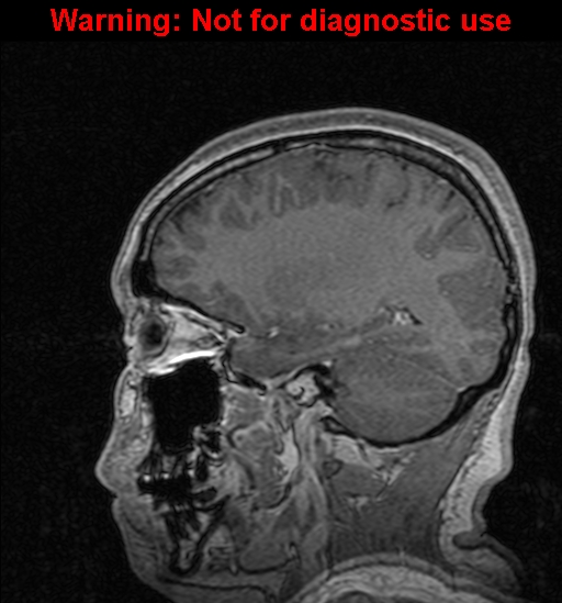 Cerebral venous thrombosis (Radiopaedia 37224-39208 Sagittal T1 C+ 52).jpg