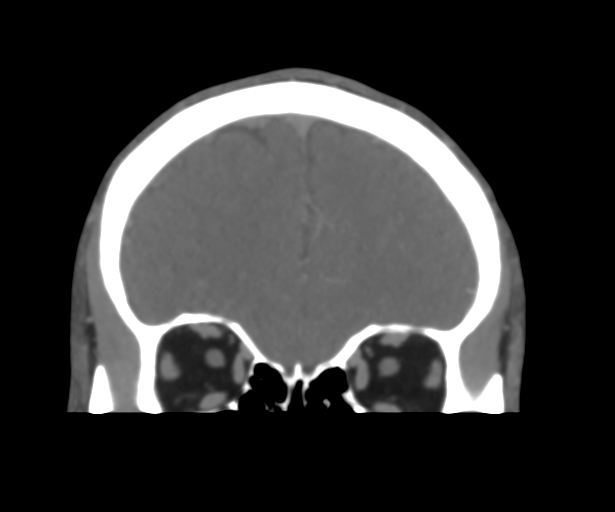 File:Cerebral venous thrombosis (Radiopaedia 38392-40467 Coronal CTA-Venogram 15).png