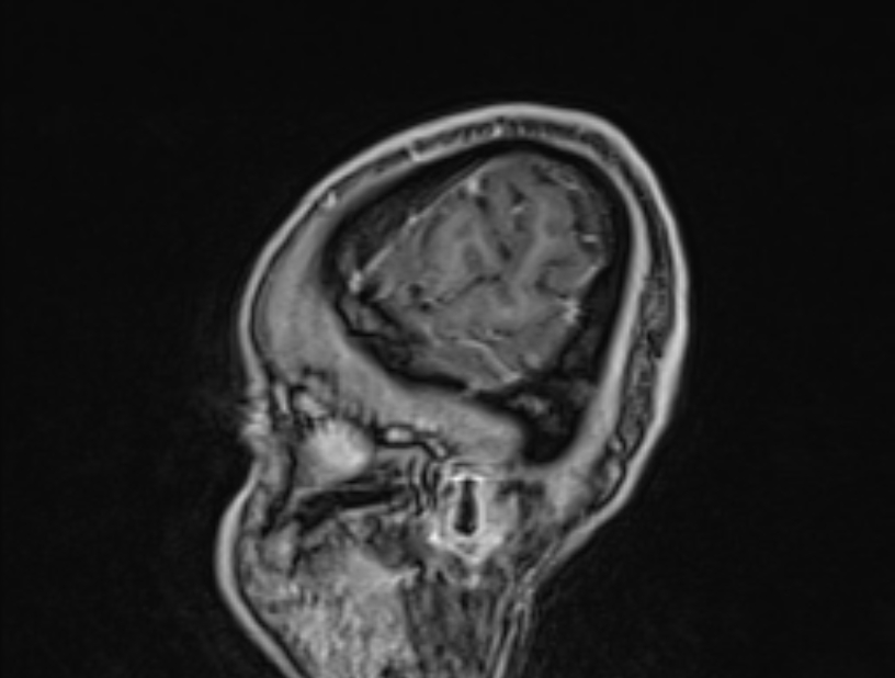 Cerebral venous thrombosis (Radiopaedia 71207-81504 Sagittal T1 C+ 60).jpg