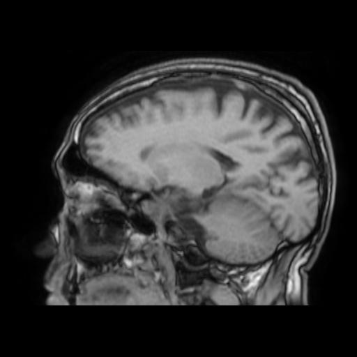 File:Cerebral venous thrombosis with secondary intracranial hypertension (Radiopaedia 89842-106957 Sagittal T1 19).jpg