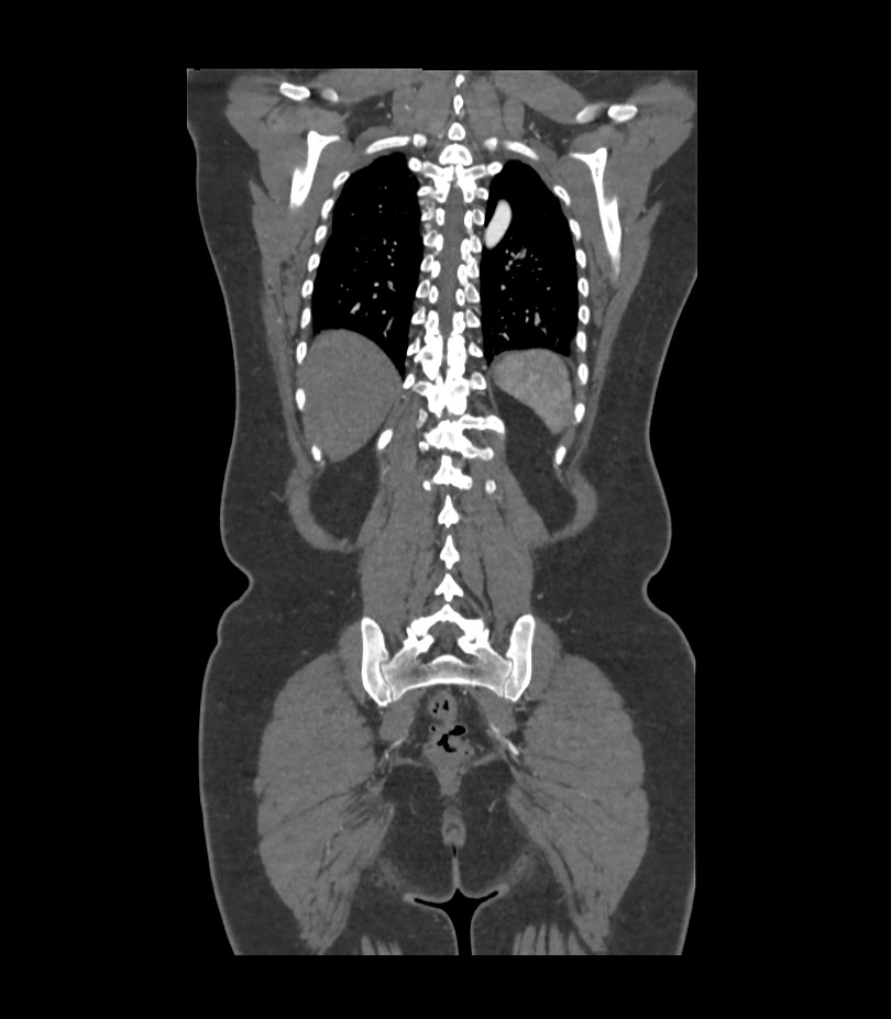 Cervical aortic arch with coarctation and aneurysms (Radiopaedia 44035-47552 C 9).jpg