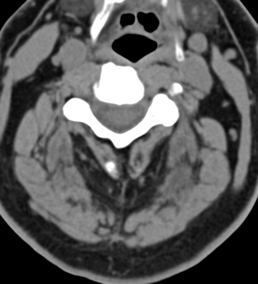 File:Cervical canal stenosis - OPLL and osteophytes (Radiopaedia 47329-51910 Axial non-contrast 26).png
