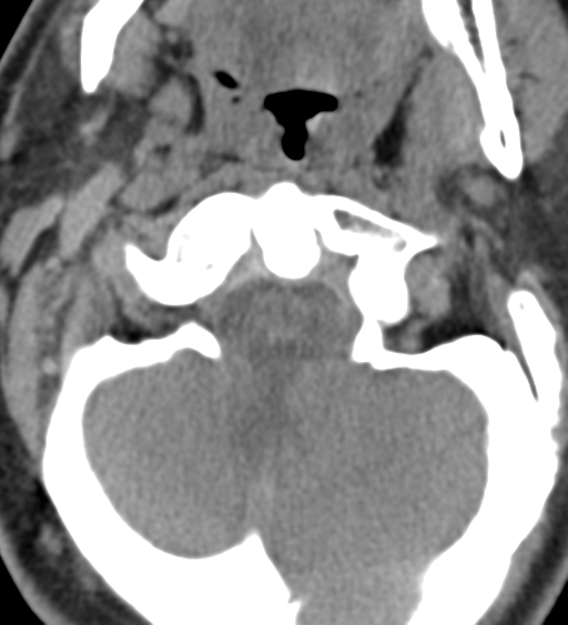 File:Cervical canal stenosis due to ossification of the posterior longitudinal ligament (Radiopaedia 47260-51823 Axial non-contrast 12).png