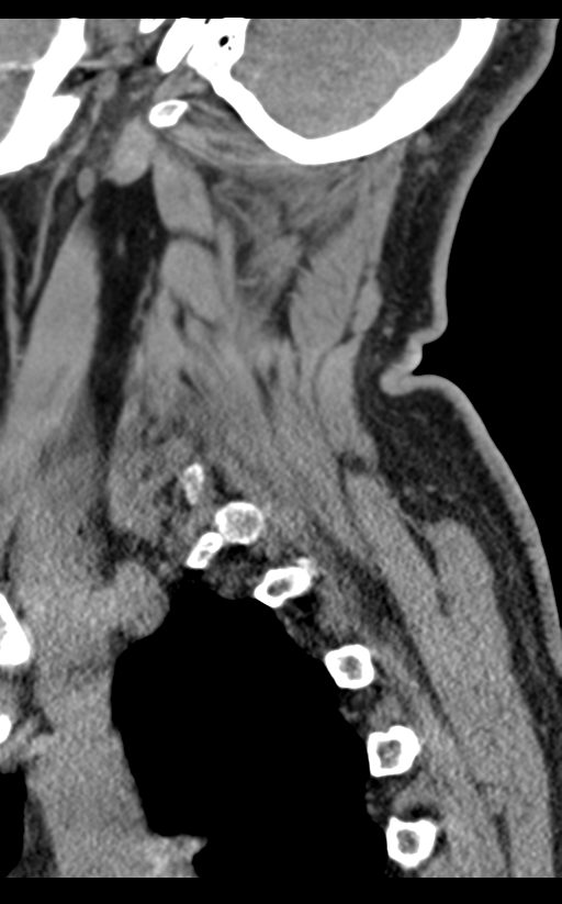 Cervical canal stenosis due to ossification of the posterior longitudinal ligament (Radiopaedia 47260-51823 D 66).png