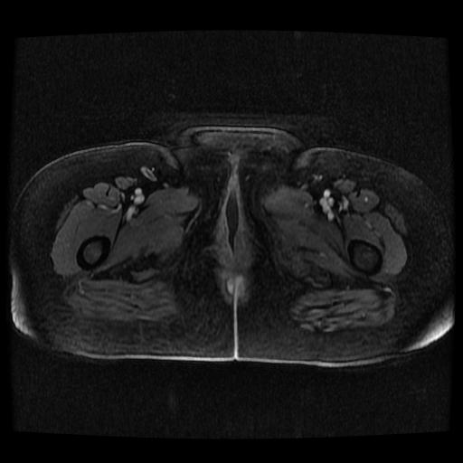 File:Cervical carcinoma (Radiopaedia 70924-81132 Axial T1 C+ fat sat 15).jpg