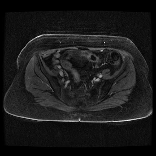 Cervical carcinoma (Radiopaedia 70924-81132 Axial T1 C+ fat sat 153).jpg