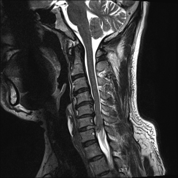 File:Cervical disc extrusion (Radiopaedia 53950-60077 Sagittal T2 10).jpg