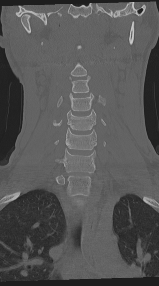 Cervical intercalary bone (Radiopaedia 35211-36748 Coronal bone window 31).png