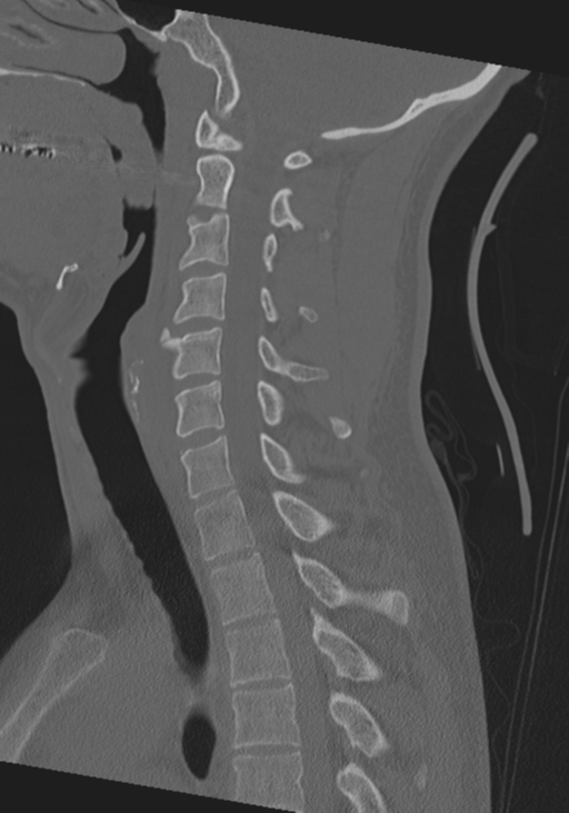 Cervical intercalary bone (Radiopaedia 35211-36748 Sagittal bone window 36).png