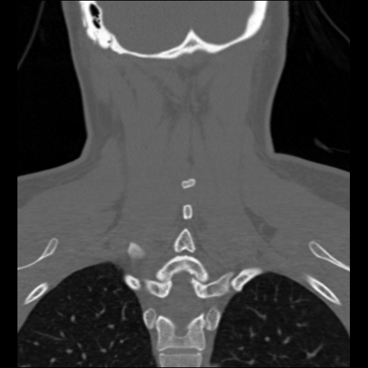 File:Cervical rib (Radiopaedia 71110-81363 Coronal non-contrast 15).jpg