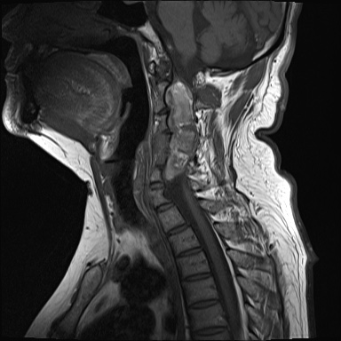 File:Cervical spinal neurofibroma in a patient with NF1 (Radiopaedia 58344-65465 Sagittal T1 7).jpg
