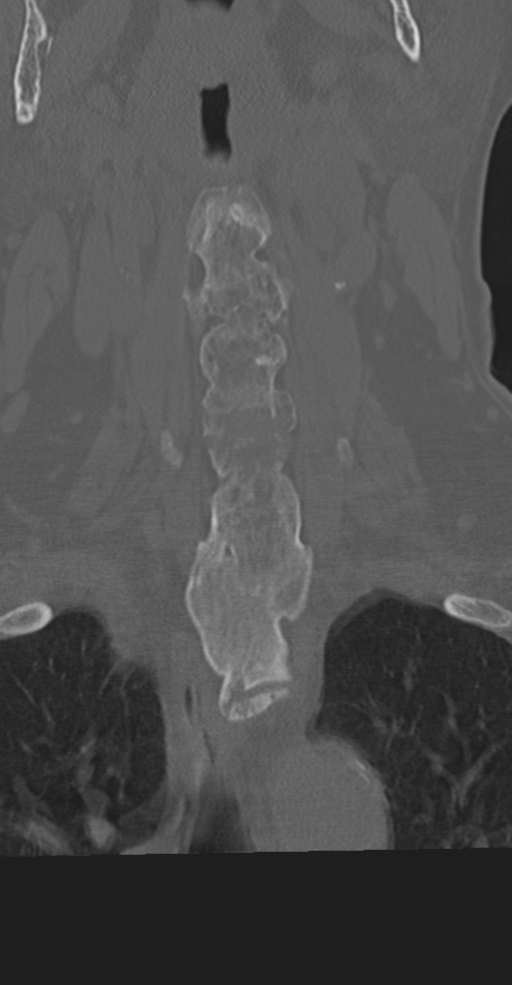 Cervical spine fracture in the setting of ankylosis (Radiopaedia 37038-38715 Coronal bone window 21).png