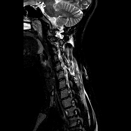 File:Cervical spine posterior ligamentous complex rupture (Radiopaedia 63486-72103 Sagittal STIR 4).jpg