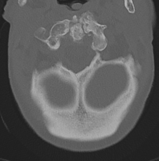 File:Cervical spondylolysis (Radiopaedia 49616-54811 Axial bone window 12).png