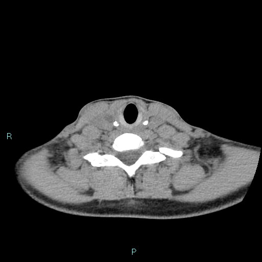 Cervical thymic cyst (Radiopaedia 88632-105335 Axial non-contrast 43).jpg