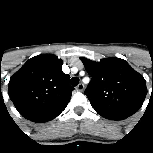 Cervical thymic cyst (Radiopaedia 88632-105335 B 5).jpg