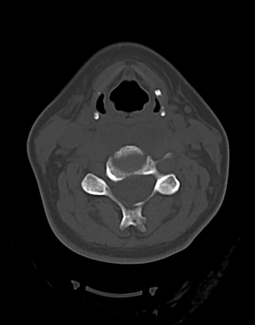 Cervical tuberculous spondylitis (Radiopaedia 39149-41365 Axial bone window 25).png