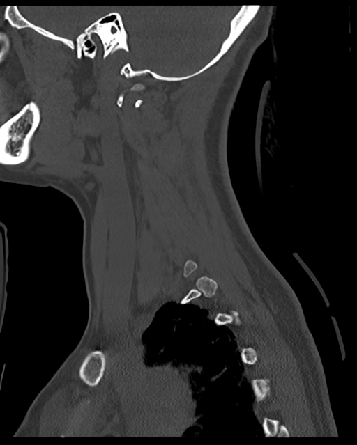 Cervical tuberculous spondylitis (Radiopaedia 39149-41365 Sagittal bone window 54).png