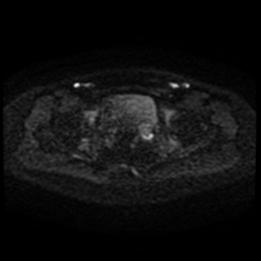 File:Cesarian section scar endometriosis (Radiopaedia 66520-75799 Axial DWI 69).jpg