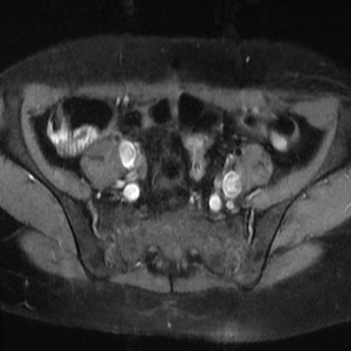File:Cesarian section scar endometriosis (Radiopaedia 66520-75799 Axial T1 fat sat 4).jpg