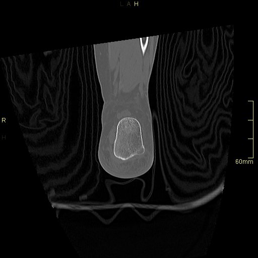 Chaput tubercle fracture (Radiopaedia 80319-93956 Coronal non-contrast 55).jpg