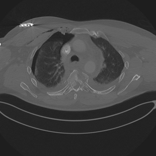 File:Chest multitrauma - aortic injury (Radiopaedia 34708-36147 Axial bone window 103).png