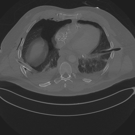 Chest multitrauma - aortic injury (Radiopaedia 34708-36147 Axial bone window 199).png