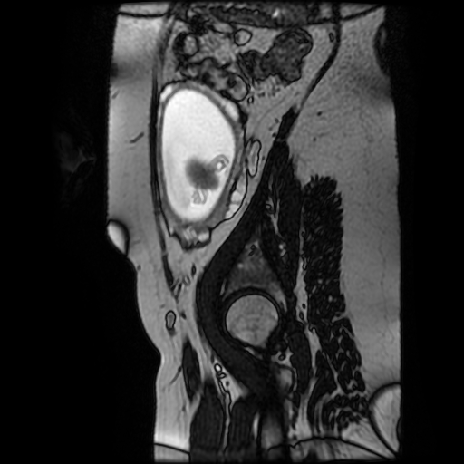 Chiari II malformation - fetal MRI (Radiopaedia 68099-77581 Sagittal Fiesta 8).jpg