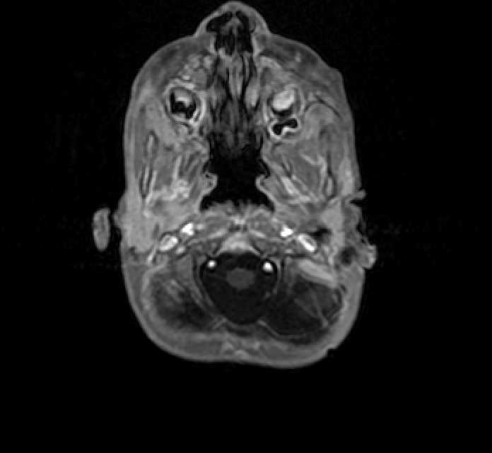 Chiasmatic-hypothalamic glioma (Radiopaedia 90079-107252 Axial T1 C+ 4).jpg