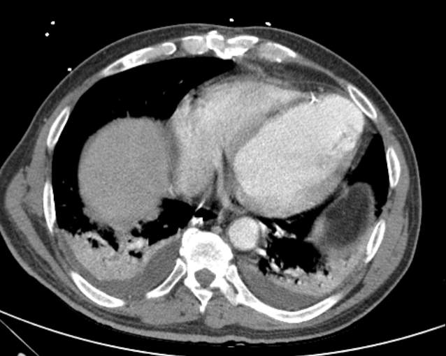 Cholecystitis - perforated gallbladder (Radiopaedia 57038-63916 A 9).jpg