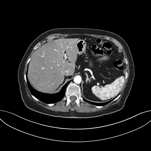 Cholecystoduodenal fistula due to calculous cholecystitis with gallstone migration (Radiopaedia 86875-103077 A 18).jpg