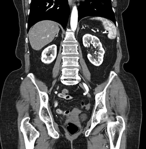 File:Cholecystoduodenal fistula due to calculous cholecystitis with gallstone migration (Radiopaedia 86875-103077 B 30).jpg