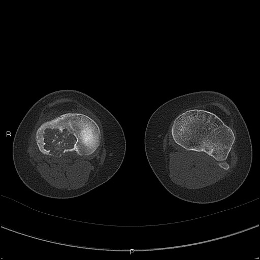 Chondroblastoma (Radiopaedia 62721-71030 Axial bone window 50).jpg